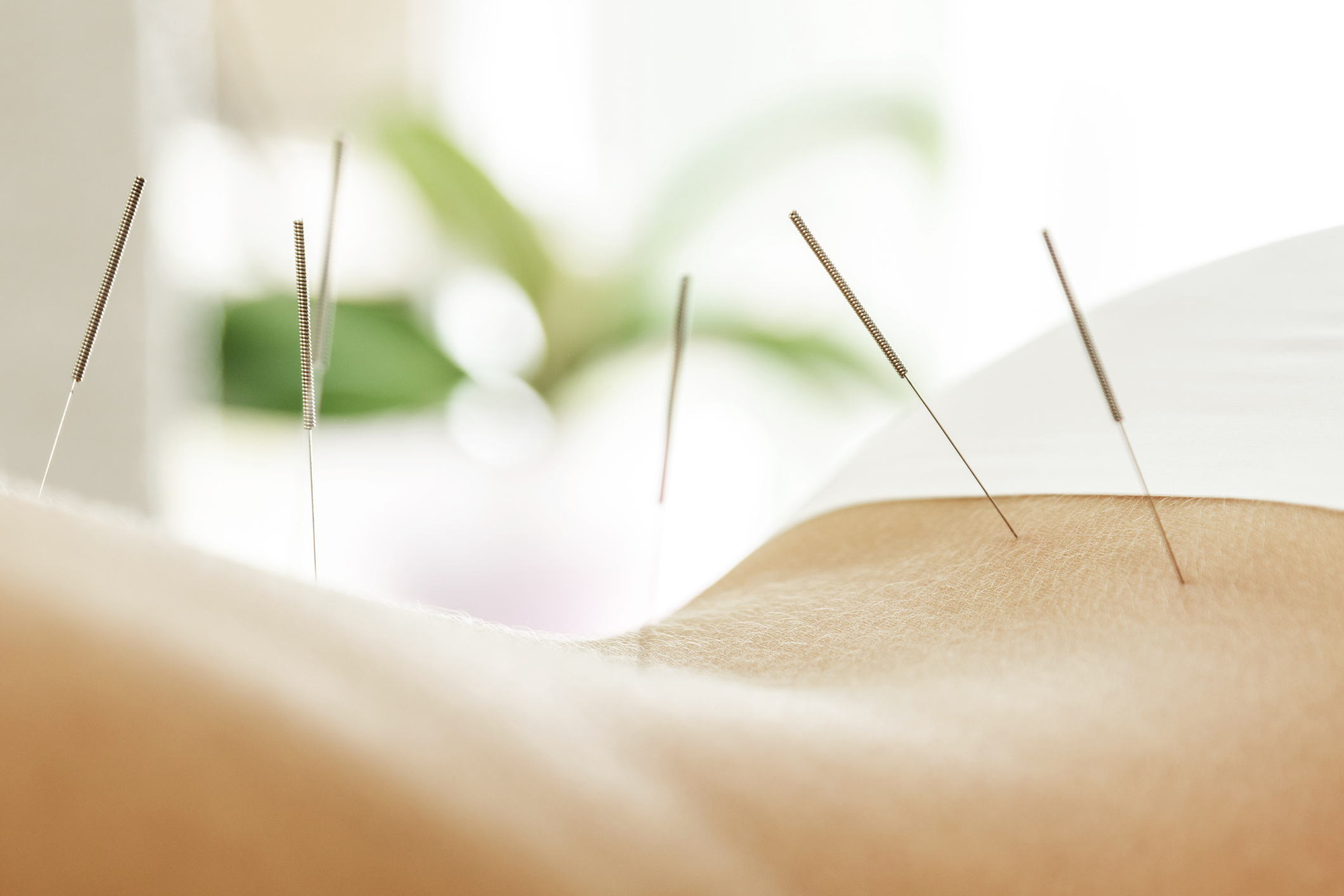 You are currently viewing Acupuncture Treatments in West LA and San Pedro CA